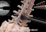 create 3d medical spine surgery animation surgical device 3d orthopaedic implant